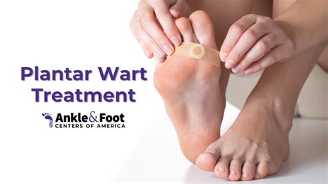 Wart Treatment