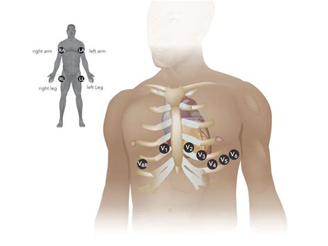 ECG Placement for Women