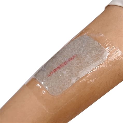 Wound dressings and creams for 2nd degree burns