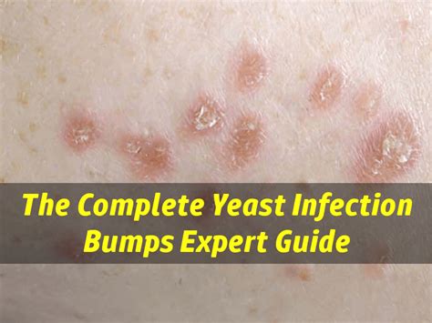 Yeast Infection Bumps Causes Symptoms And Treatment
