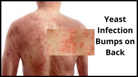 Yeast Infection Bumps Prevention